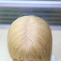 Golden hair implanted