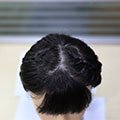 Schwarzes Haar implantiert