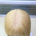 Goldenes Haar implantiert